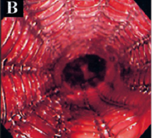 Airway Stent