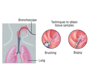 Biopsy