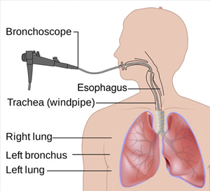 Bronchoscope