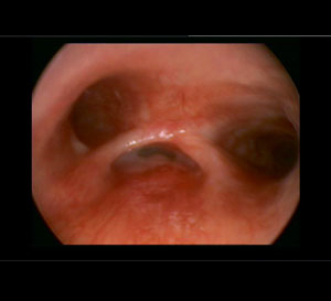 Bronchoscope